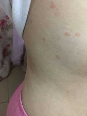 孕期乳房周围斑点（孕期乳房周围斑点怎么回事）  第1张