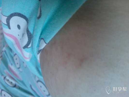 孕期乳房周围斑点（孕期乳房周围斑点怎么回事）  第2张