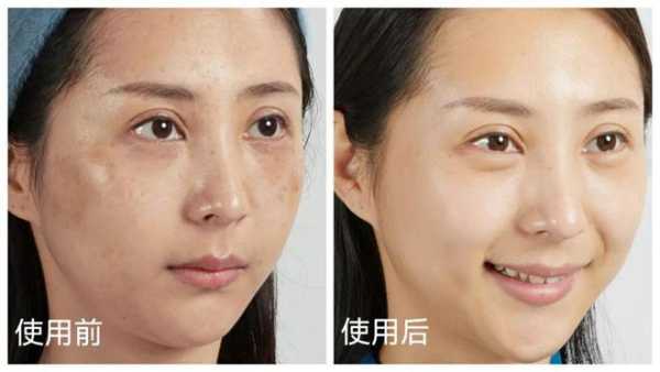 孕期怎样祛斑(孕期怎样祛斑最有效) 第2张 孕期怎样祛斑(孕期怎样祛斑最有效) 第2张