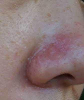 孕妇鼻子发炎可以涂红霉素眼膏吗,孕期鼻翼长痘是什么原因 第2张 孕妇鼻子发炎可以涂红霉素眼膏吗,孕期鼻翼长痘是什么原因 第2张
