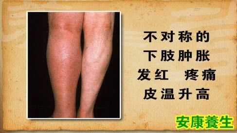 孕期腿血栓图片(孕期腿血栓图片) 第1张 孕期腿血栓图片(孕期腿血栓图片) 第1张