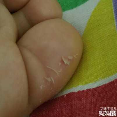 九个月宝宝。手上长倒刺怎么回事,胎儿手掌缺如的几率 第2张 九个月宝宝。手上长倒刺怎么回事,胎儿手掌缺如的几率 第2张