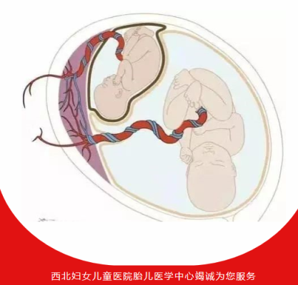 胎儿输血综合征(胎儿输血综合征) 第1张 胎儿输血综合征(胎儿输血综合征) 第1张