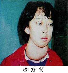 请问大家甲亢对胎儿智力的影响大吗,孕期甲亢胎儿聪明的表现 第2张 请问大家甲亢对胎儿智力的影响大吗,孕期甲亢胎儿聪明的表现 第2张