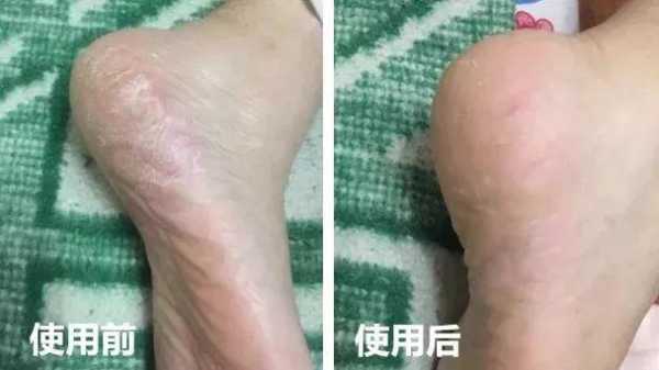 我的脚后跟裂开了,有裂口疼怎么办呢,孕期后脚跟裂了可以擦什么乳效果好 第1张 我的脚后跟裂开了,有裂口疼怎么办呢,孕期后脚跟裂了可以擦什么乳效果好 第1张
