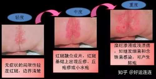 孕如何预防胎儿湿疹(孕如何预防胎儿湿疹) 第2张 孕如何预防胎儿湿疹(孕如何预防胎儿湿疹) 第2张