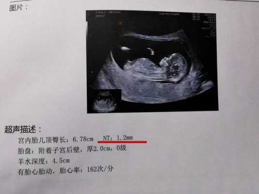 20胎儿心跳多少正常(胎儿心率150正常吗?怀孕五个月多了,可以检查畸形问题了吗) 第1张 20胎儿心跳多少正常(胎儿心率150正常吗?怀孕五个月多了,可以检查畸形问题了吗) 第1张