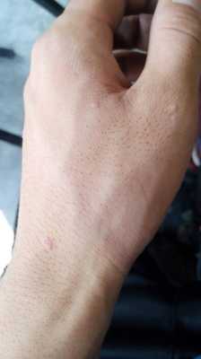 手背上长斑是什么原因,孕期手背长斑怎么回事 第3张 手背上长斑是什么原因,孕期手背长斑怎么回事 第3张