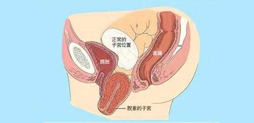 孕期子宫下垂图片(孕妇下坠感是什么感觉) 第2张 孕期子宫下垂图片(孕妇下坠感是什么感觉) 第2张