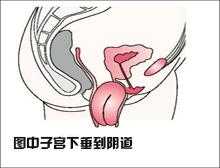 孕期子宫下垂图片(孕妇下坠感是什么感觉) 第1张 孕期子宫下垂图片(孕妇下坠感是什么感觉) 第1张