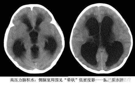 胎儿脑积水诊断标准(宝宝脑积水的初期表现是什么样的) 第1张 胎儿脑积水诊断标准(宝宝脑积水的初期表现是什么样的) 第1张