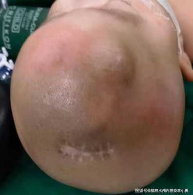 胎儿脑积水诊断标准(宝宝脑积水的初期表现是什么样的) 第2张 胎儿脑积水诊断标准(宝宝脑积水的初期表现是什么样的) 第2张