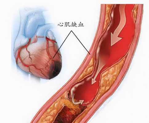 心肌缺血是什么意思,孕期心肌缺血对孩子有影响吗 第2张 心肌缺血是什么意思,孕期心肌缺血对孩子有影响吗 第2张