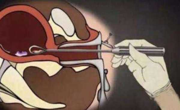 胎儿半椎体必须引产吗?孕中期时候了,要怎么处理安全啊,胎儿半椎体畸形能要吗 第1张 胎儿半椎体必须引产吗?孕中期时候了,要怎么处理安全啊,胎儿半椎体畸形能要吗 第1张