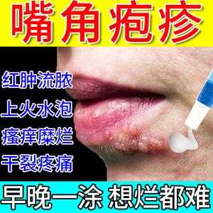 有孕期长了口唇疱疹的吗,孕期嘴唇疱疹可以擦什么药  第1张