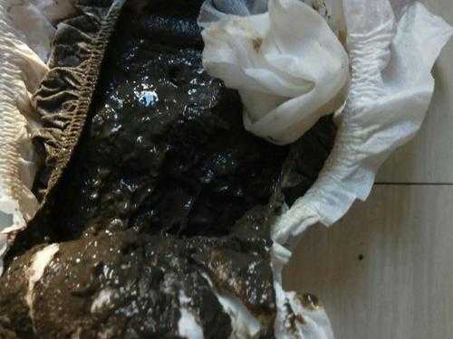 孕妇大便黑色怎么回事,孕期隐血是什么原因引起 第2张 孕妇大便黑色怎么回事,孕期隐血是什么原因引起 第2张