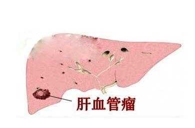胎儿肝脏血管瘤怎么办,如何预防胎儿血管瘤形成原因 第1张 胎儿肝脏血管瘤怎么办,如何预防胎儿血管瘤形成原因 第1张