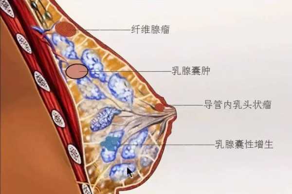 乳腺增生是怎么得的,孕期会乳腺增生吗? 第1张 乳腺增生是怎么得的,孕期会乳腺增生吗? 第1张