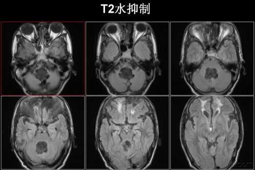 胎儿后颅窝是什么(后颅窝池吸收的高峰期是什么时候) 第1张 胎儿后颅窝是什么(后颅窝池吸收的高峰期是什么时候) 第1张