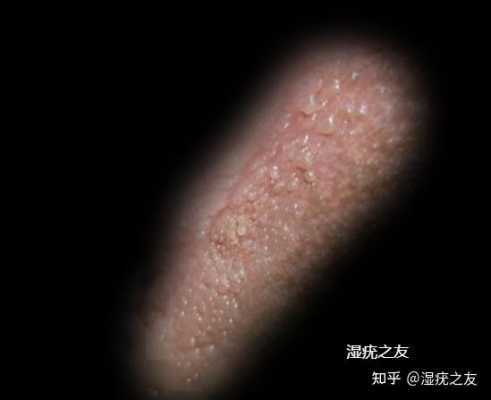 尖锐湿庞胎儿还能要吗(我得了尖锐湿疣,可以要孩子吗) 第1张 尖锐湿庞胎儿还能要吗(我得了尖锐湿疣,可以要孩子吗) 第1张