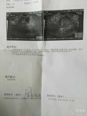 盆腔积液影响胎儿发育吗(盆腔积液影响胎儿发育吗女性) 第2张 盆腔积液影响胎儿发育吗(盆腔积液影响胎儿发育吗女性) 第2张