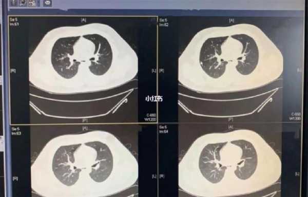 支气管哮喘对生肓有影响吗,孕妇哮喘对胎儿的影响大吗 第2张 支气管哮喘对生肓有影响吗,孕妇哮喘对胎儿的影响大吗 第2张