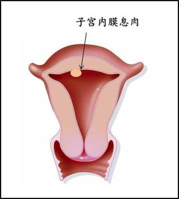 孕期息肉怎样预防感染(子宫内膜息肉怎么预防复发) 第1张 孕期息肉怎样预防感染(子宫内膜息肉怎么预防复发) 第1张