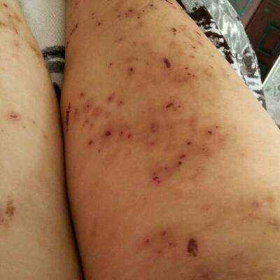 孕妇胆淤最晚什么时候生产?有哪些需要注意的事情,哪些孕妇容易得胆淤症 第2张 孕妇胆淤最晚什么时候生产?有哪些需要注意的事情,哪些孕妇容易得胆淤症 第2张