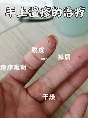 孕期长湿疹怎么用药(孕期长湿疹怎么用药) 第1张 孕期长湿疹怎么用药(孕期长湿疹怎么用药) 第1张