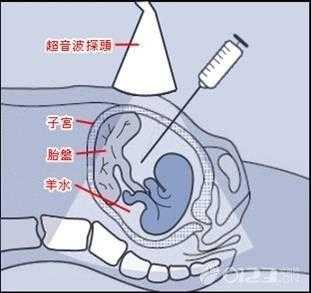 羊水穿刺12天胎儿死亡（羊水穿刺检查做完了宝宝生下来会健康吗）  第2张