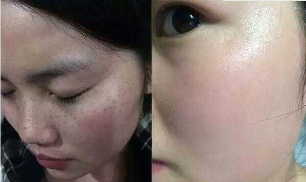 如何防止孕期长斑(如何防止孕期长斑暗黄) 第3张 如何防止孕期长斑(如何防止孕期长斑暗黄) 第3张