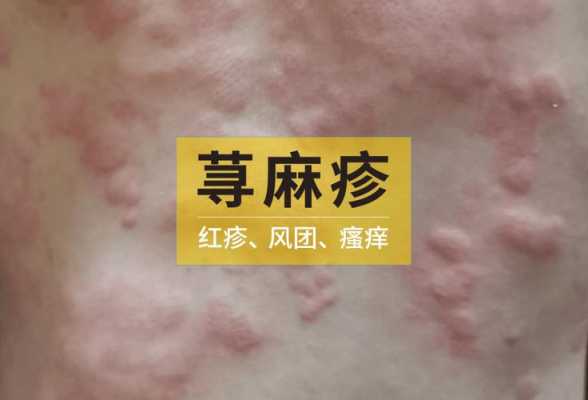 孕期起荨麻疹(孕早期得了荨麻疹怎么办) 第2张 孕期起荨麻疹(孕早期得了荨麻疹怎么办) 第2张