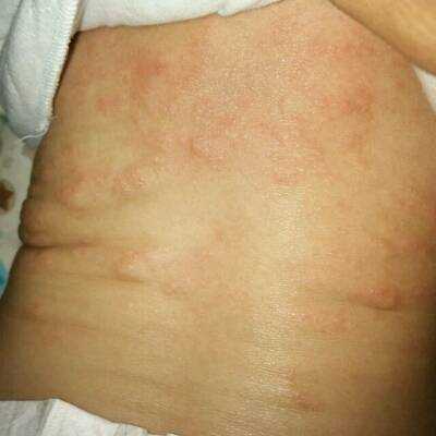 妊娠湿疹对胎儿的影响(妊娠湿疹对胎儿的影响) 第2张 妊娠湿疹对胎儿的影响(妊娠湿疹对胎儿的影响) 第2张