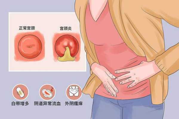 怀孕期间宫颈息肉会导致出血吗,孕期宫颈息肉出血症状有哪些  第2张