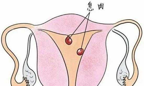 孕期宫颈息肉,大便后就有少量出血,该怎么办,孕期怎样预防息肉出血呢 第2张 孕期宫颈息肉,大便后就有少量出血,该怎么办,孕期怎样预防息肉出血呢 第2张