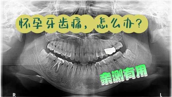 孕期能种牙吗（孕期能种牙吗）  第2张