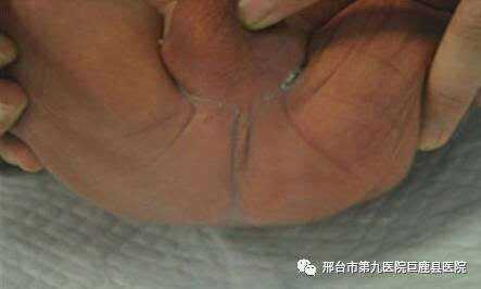 胎儿肛门闭锁孕妇有什么症状,胎儿无肛门是什么原因引起的 第1张 胎儿肛门闭锁孕妇有什么症状,胎儿无肛门是什么原因引起的 第1张