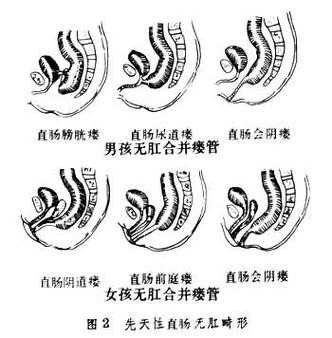 胎儿肛门闭锁孕妇有什么症状,胎儿无肛门是什么原因引起的 第2张 胎儿肛门闭锁孕妇有什么症状,胎儿无肛门是什么原因引起的 第2张