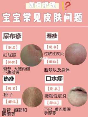 孕期怎么预防婴儿湿疹(怀孕期间一直长湿疹,对宝宝有没有影响) 第2张 孕期怎么预防婴儿湿疹(怀孕期间一直长湿疹,对宝宝有没有影响) 第2张