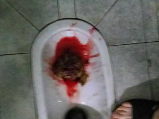 孕期上厕所大便出血(孕妇便秘,拉大便好多血是怎么回事呢) 第2张 孕期上厕所大便出血(孕妇便秘,拉大便好多血是怎么回事呢) 第2张