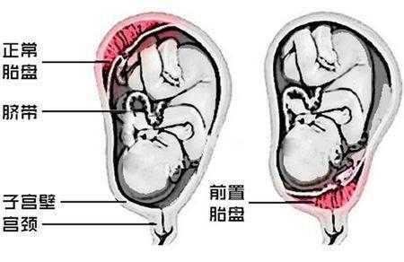 胎盘前壁和后壁胎儿图(胎盘前壁和后壁胎儿图片对比) 第1张 胎盘前壁和后壁胎儿图(胎盘前壁和后壁胎儿图片对比) 第1张