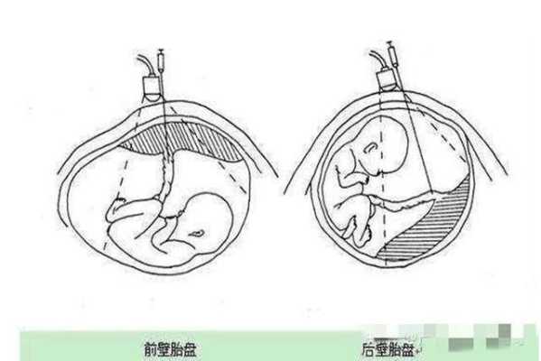 胎盘前壁和后壁胎儿图(胎盘前壁和后壁胎儿图片对比) 第2张 胎盘前壁和后壁胎儿图(胎盘前壁和后壁胎儿图片对比) 第2张