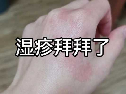 孕期湿疹最佳治疗方法(孕妇得了湿疹用什么药?孕妇身上长湿疹会对胎儿有影响吗) 第3张 孕期湿疹最佳治疗方法(孕妇得了湿疹用什么药?孕妇身上长湿疹会对胎儿有影响吗) 第3张