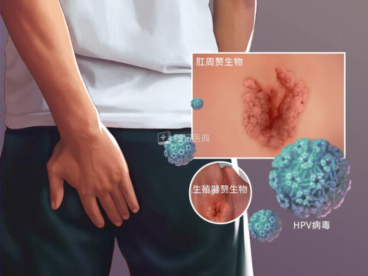 尖锐湿疣能要孩子吗,尖湿锐尤会影响胎儿吗 第2张 尖锐湿疣能要孩子吗,尖湿锐尤会影响胎儿吗 第2张