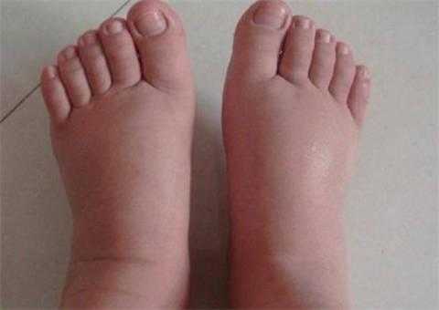 孕期水肿生女儿吗(孕期为什么会水肿) 第3张 孕期水肿生女儿吗(孕期为什么会水肿) 第3张