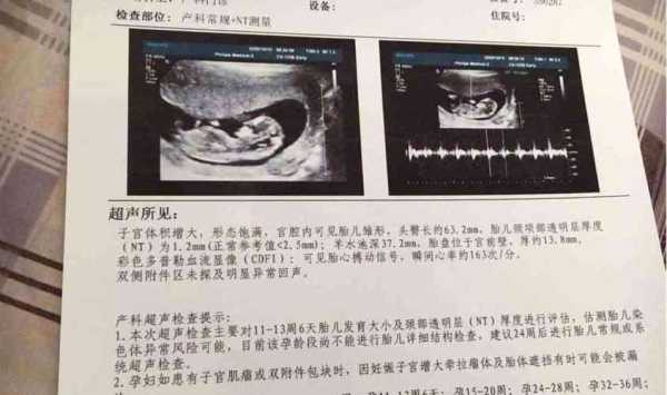 刚出生的婴儿怎么辨别男孩女孩,孕期男孩女孩的区别nt单怎么看 第3张 刚出生的婴儿怎么辨别男孩女孩,孕期男孩女孩的区别nt单怎么看 第3张