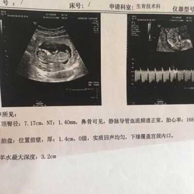 刚出生的婴儿怎么辨别男孩女孩,孕期男孩女孩的区别nt单怎么看 第2张 刚出生的婴儿怎么辨别男孩女孩,孕期男孩女孩的区别nt单怎么看 第2张