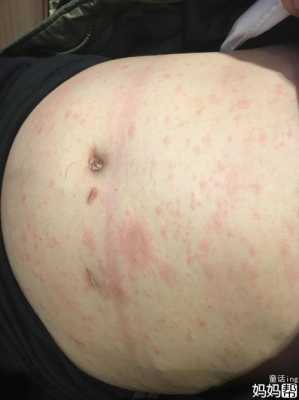 孕期肚皮长红点点(孕期肚皮长红点点对胎儿有影响吗) 第2张 孕期肚皮长红点点(孕期肚皮长红点点对胎儿有影响吗) 第2张