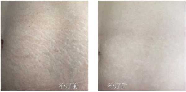 孕期无妊娠纹(怎么才能没有妊娠纹) 第2张 孕期无妊娠纹(怎么才能没有妊娠纹) 第2张