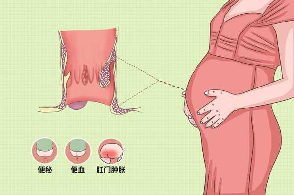 孕妇痔疮出血影响胎儿(孕妇痔疮出血影响胎儿发育吗) 第1张 孕妇痔疮出血影响胎儿(孕妇痔疮出血影响胎儿发育吗) 第1张